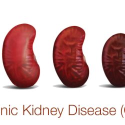 Kidney chronic risk ckd renal kidneys acute problems contribute include